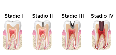 progressione della carie